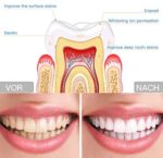 Teeth Whitening Kit Zahnaufhellung Set – Bild 7