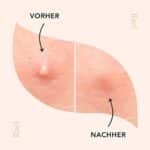 Rael Hydrokolloid Akne Pimple Patch - Unsichtbar, Makelfleck, Hydrokolloid, Hautbehandlung, zwei Grössen (96 count) – Bild 7