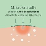 Rael Mikrokristall Akne Healing Patches - Pickel Akne Spot Tea Tree Treatment (1 Packung,9 Pflaster) – Bild 5