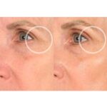 SiO Beauty FaceLift - Wiederverwendbare Anti-Falten-Pflaster für Hals, Stirn, Augen & Lächeln